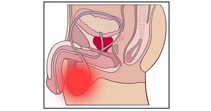O complicație a intervenției chirurgicale de mărire a penisului poate fi inflamația testiculelor. 