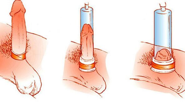 Principiul de funcționare al unei pompe de vid care poate mări penisul
